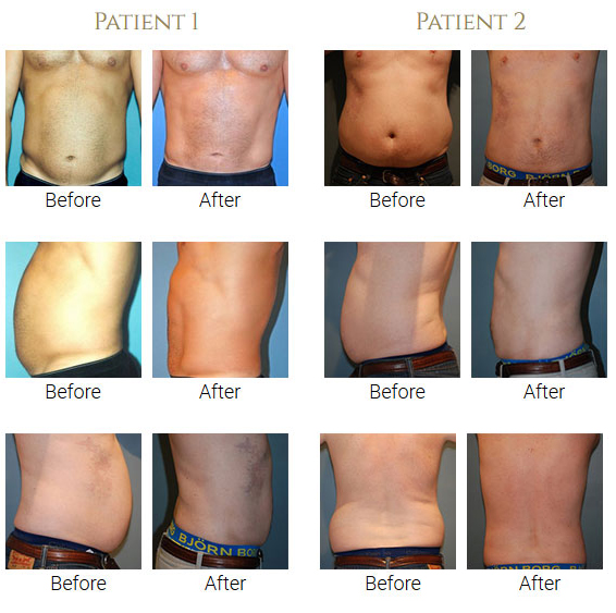 beforeafter