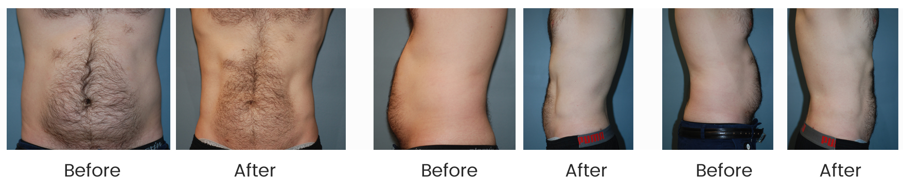 Liposuction Specialist Rockefeller Center | Liposuction Specialist Diamond District