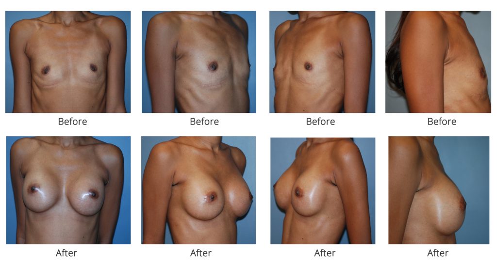 breast-augmentation-specialist-nyc-2