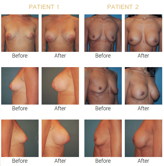 breast